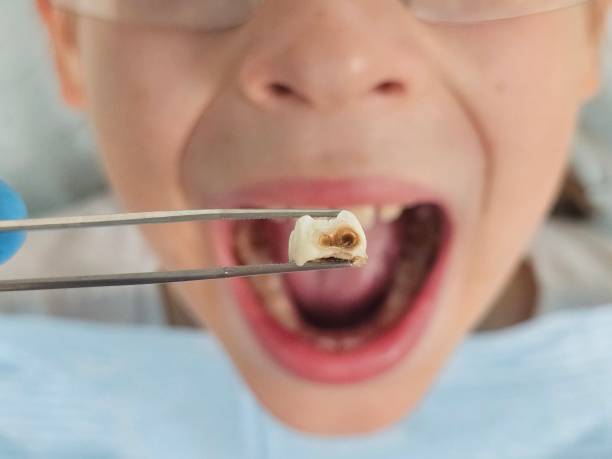 Best Emergency Broken Tooth Repair in Elmwood, IL